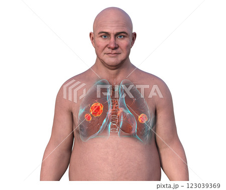 Lung mucormycosis, 3D illustration 123039369