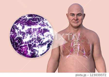 Man with silicosis, 3D illustration and light micrograph 123039372