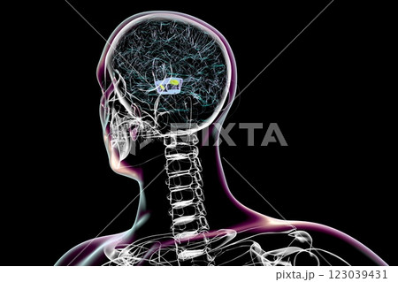 Atrophic substantia nigra in Parkinson's disease, 3D illustration Atrophic substantia nigra in Parkinson's disease, 3D illustration 123039431