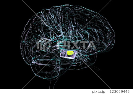 Atrophic substantia nigra in Parkinson's disease, 3D illustration 123039443