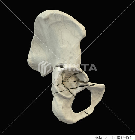 Acetabulum fracture, 3D illustration 123039454