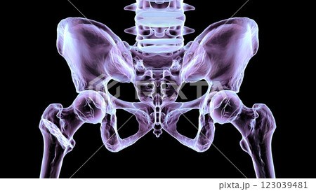 Intertrochanteric femur fracture, 3D illustration 123039481