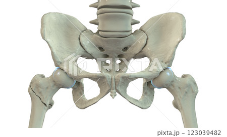 Intertrochanteric femur fracture, 3D illustration 123039482