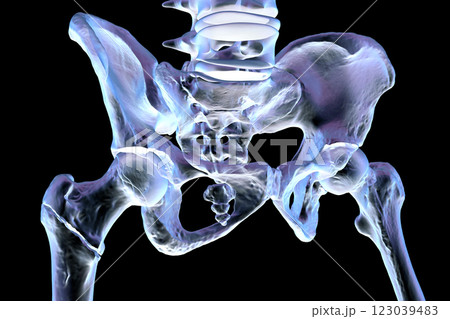 Intertrochanteric femur fracture, 3D illustration 123039483