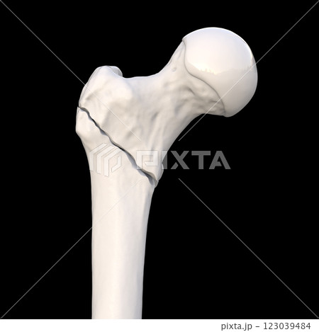 Intertrochanteric femur fracture, 3D illustration 123039484