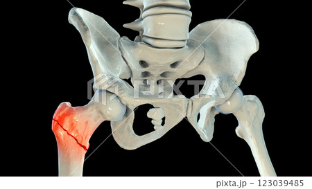 Intertrochanteric femur fracture, 3D illustration 123039485