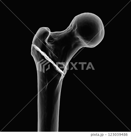 Intertrochanteric femur fracture, 3D illustration 123039486