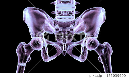 Subtrochanteric femur fracture, 3D illustration Subtrochanteric femur fracture, 3D illustration 123039490