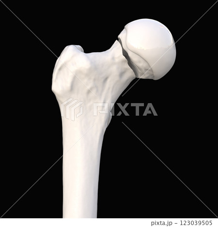 Subcapital femur fracture, 3D illustration Subcapital femur fracture, 3D illustration 123039505