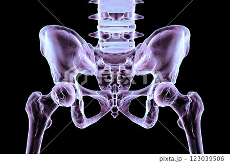 Subcapital femur fracture, 3D illustration 123039506