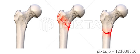 Femur fracture types: normal femur, intertrochanteric fracture, and subtrochanteric fracture, 3D illustration Femur fracture types: normal femur, intertrochanteric fracture, and subtrochanteric fracture, 3D illustration 123039510
