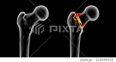 Basicervical femur fracture, 3D illustration Basicervical femur fracture, 3D illustration 123039518
