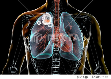 Cavitary tuberculosis, 3D illustration 123039546