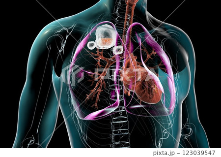 Cavitary tuberculosis, 3D illustration 123039547