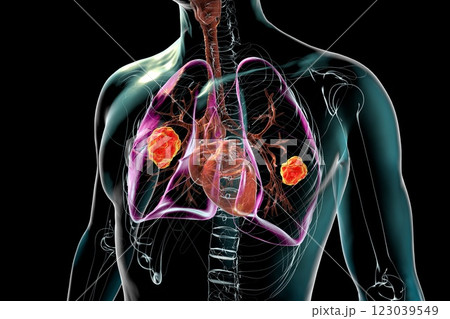 Lung mucormycosis, 3D illustration 123039549