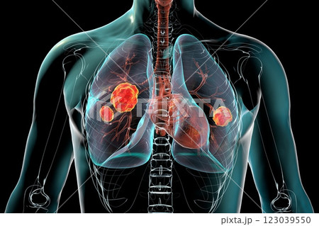 Lung mucormycosis, 3D illustration 123039550