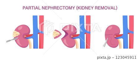 Partial Nephrectomy Surgery. Partial Nephrectomy Kidney Removal. Cross Section. Vector medical illustration of kidney removal procedure with incision, resection, and suturing. 123045911