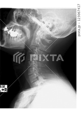 首の骨のレントゲンイメージ　(写真素材) 123067417