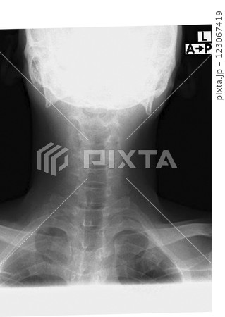 首の骨のレントゲンイメージ　(写真素材) 123067419