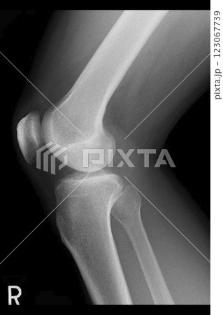 膝のレントゲンイメージ　(写真素材) 123067739