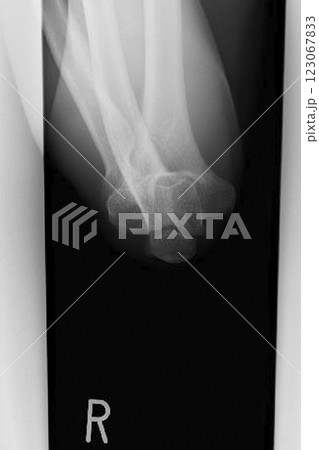 肘の骨のレントゲンイメージ　(写真素材) 123067833