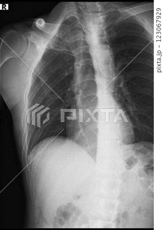 胸部と背骨のレントゲンイメージ　(写真素材) 123067929
