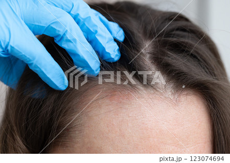 An appointment with a dermatologist. Woman has dermatitis on her scalp. An appointment with a dermatologist. Woman has dermatitis on her scalp. 123074694