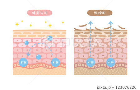 健康な肌と乾燥肌の断面図のイラスト 健康な肌と乾燥肌の断面図のイラスト 123076220
