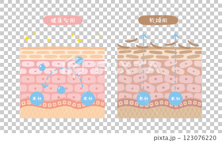 健康な肌と乾燥肌の断面図のイラスト 健康な肌と乾燥肌の断面図のイラスト 123076220