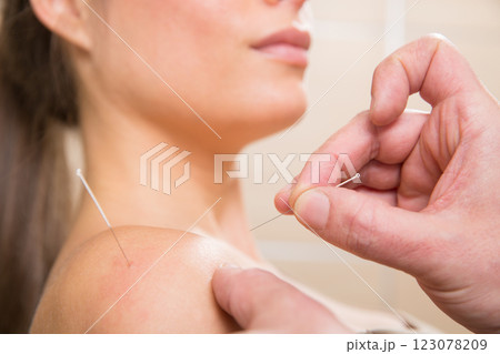 Doctor hands acupuncture needle pricking on woman 123078209