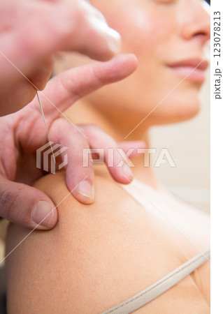 Doctor hands acupuncture needle pricking on woman Doctor hands acupuncture needle pricking on woman 123078213