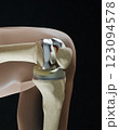 X-Ray, Total Knee Replacement is surgery to replace diseased or damaged joint surfaces of the knee with metal and plastic prosthetic devices 123094578