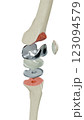 Total Knee Replacement is surgery to replace diseased or damaged joint surfaces of the knee with metal and plastic prosthetic devices.	 123094579