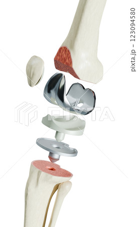 Total Knee Replacement is surgery to replace diseased or damaged joint surfaces of the knee with metal and plastic prosthetic devices. Total Knee Replacement is surgery to replace diseased or damaged joint surfaces of the knee with metal and plastic prosthetic devices. 123094580