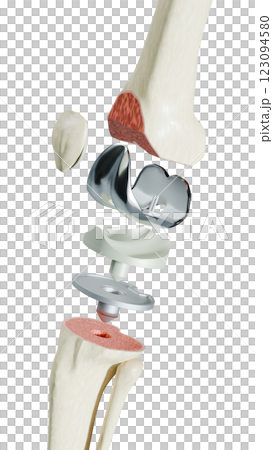 Total Knee Replacement is surgery to replace diseased or damaged joint surfaces of the knee with metal and plastic prosthetic devices. Total Knee Replacement is surgery to replace diseased or damaged joint surfaces of the knee with metal and plastic prosthetic devices. 123094580