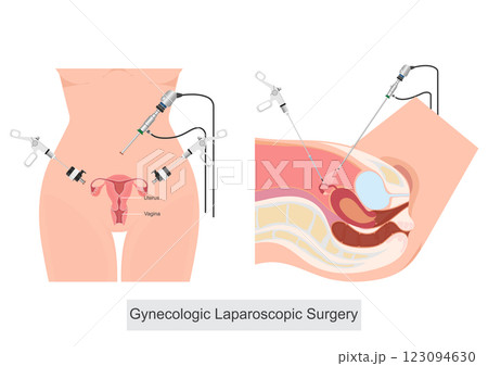 Gynecologic Laparoscopic Surgery is a minimally invasive surgical procedure. Gynecologic Laparoscopic Surgery is a minimally invasive surgical procedure. 123094630