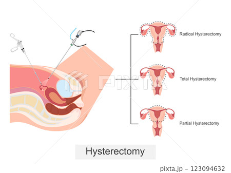 Hysterectomy is the surgical removal of the uterus Hysterectomy is the surgical removal of the uterus 123094632