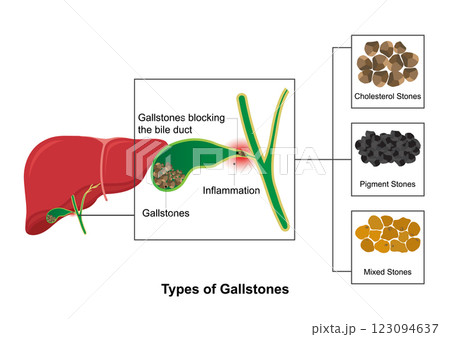 There are three main types of gallstones, 123094637