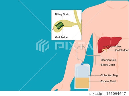 A biliary drain allows bile. A biliary drain allows bile. 123094647