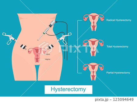 A hysterectomy is a surgical procedure to remove the womb. 123094649