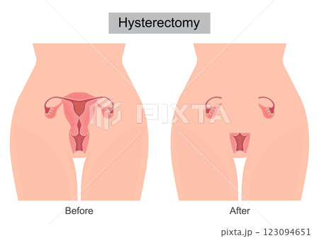 A Hysterectomy is surgery to remove the uterus. 123094651
