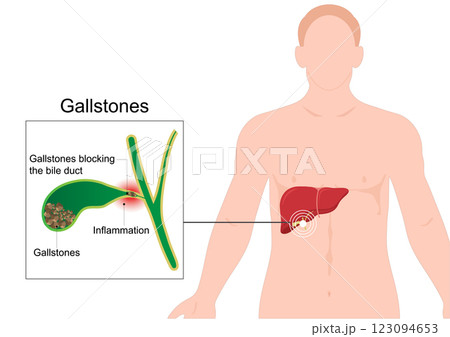 Gallstones are hardened deposits of bile. Gallstones are hardened deposits of bile. 123094653