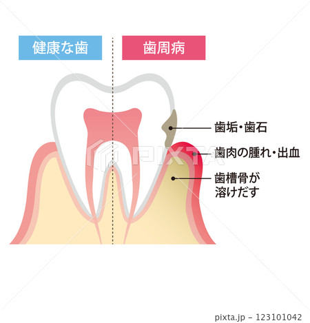 健康な歯と歯周病の歯のイラスト 健康な歯と歯周病の歯のイラスト 123101042