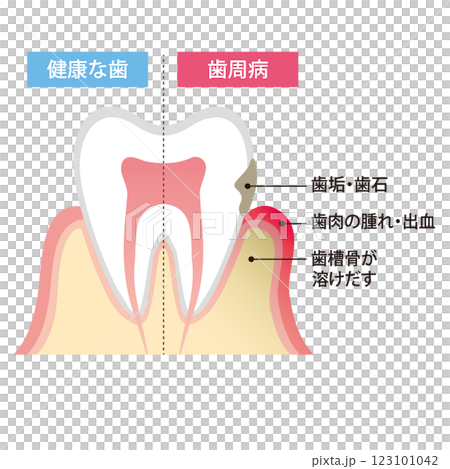 Illustration of healthy teeth and teeth with periodontal disease Illustration of healthy teeth and teeth with periodontal disease 123101042