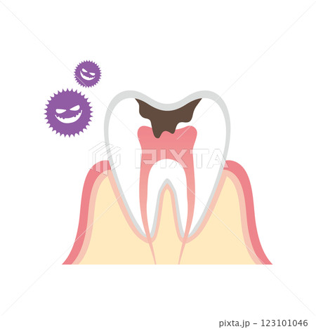 虫歯の断面図のイラスト 123101046
