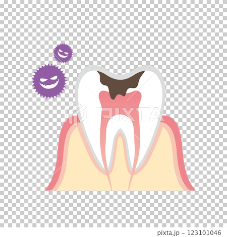 虫歯の断面図のイラスト 123101046