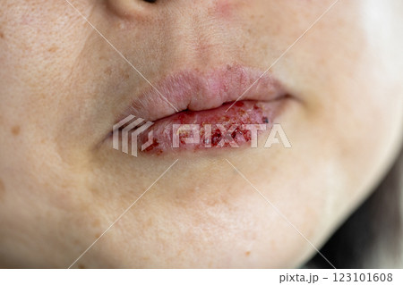 唇にヘルペスができている女性の口元 123101608