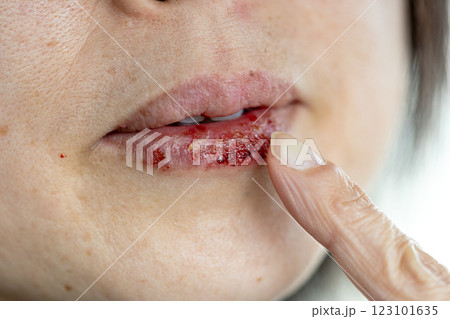 唇のヘルペスを指で触っている女性の素材写真 塗り薬を人差し指で塗っている 唇のヘルペスを指で触っている女性の素材写真 塗り薬を人差し指で塗っている 123101635
