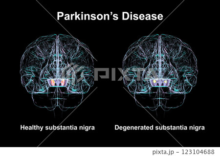 Subtantia nigra in healthy brain and Parkinson disease, 3D illustration Subtantia nigra in healthy brain and Parkinson disease, 3D illustration 123104688