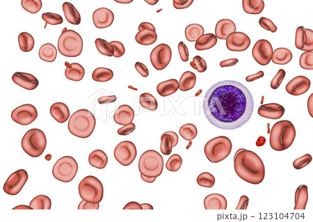 Iron deficiency anemia 123104704